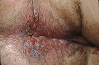 Bowen's Disease (squamous cell carcinoma in situ)